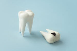 caries recurrentes