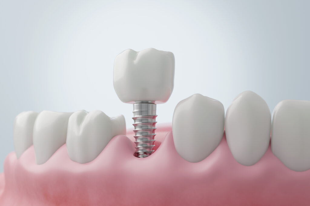 implante dental