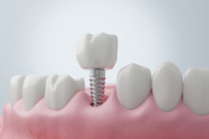 implante dental